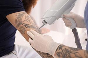 Onde encontrar equipamento para remoção de tatuagem a laser?