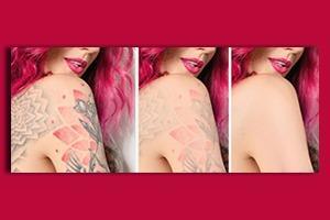 Você já conhece o aparelho de remoção de tatuagem?